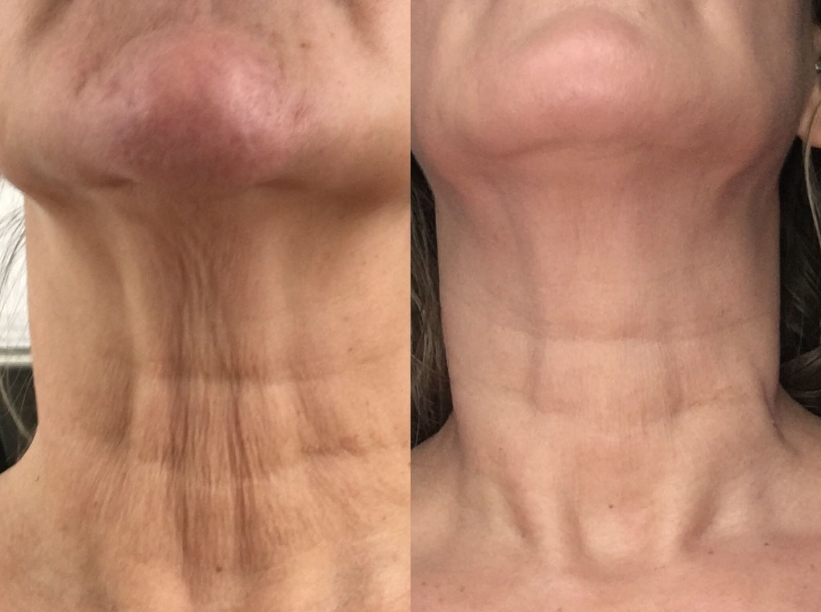 crepy-neck-removal