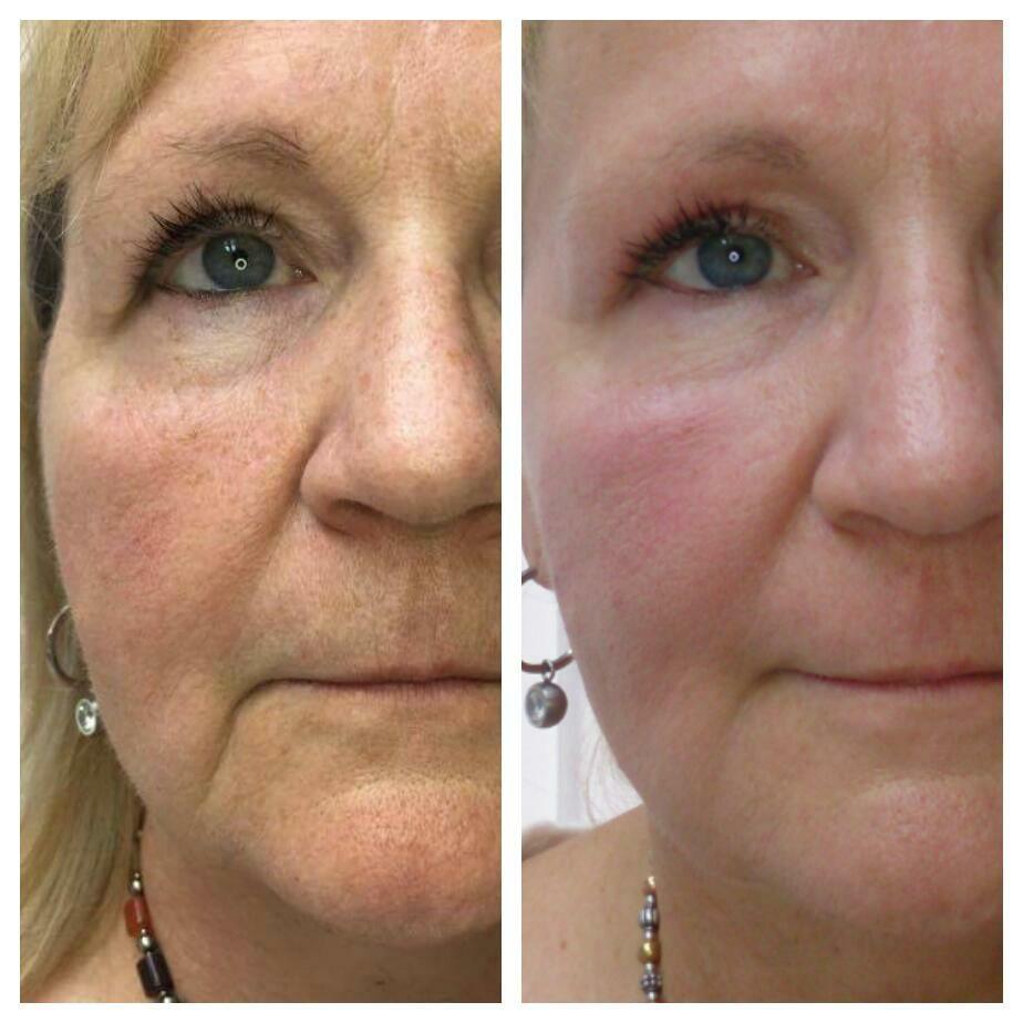 Primjer plasma lifting tretmana na licu