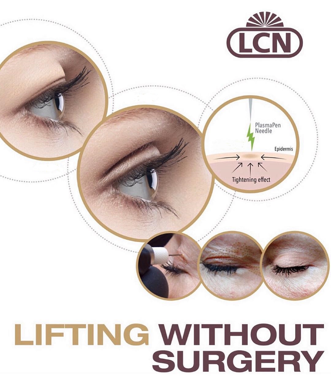 Ilustracija plasma lifting tretmana